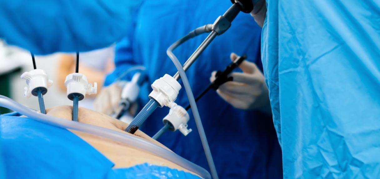 Laparoskopische chirurgische Instrumente, einschließlich Trokaren für den Zugang