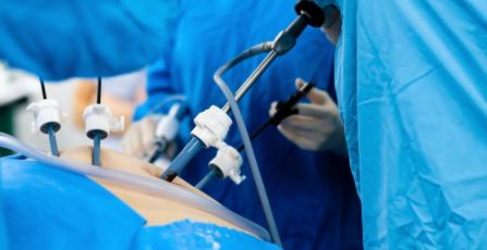 Laparoskopische chirurgische Instrumente, einschließlich Trokaren für den Zugang